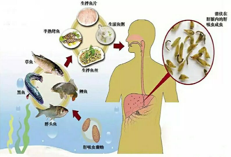 男子饮食习惯致胆道惊现7条虫，健康警示引发关注