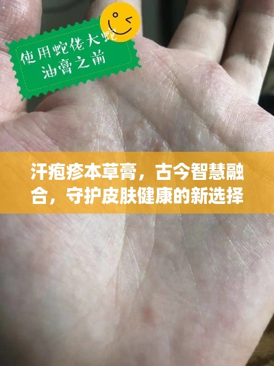 汗疱疹本草膏，古今智慧融合，守护皮肤健康的新选择