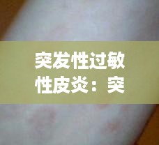 突发性过敏性皮炎：突发性过敏性皮炎怎么治疗 