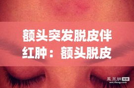 额头突发脱皮伴红肿：额头脱皮发红是什么原因 